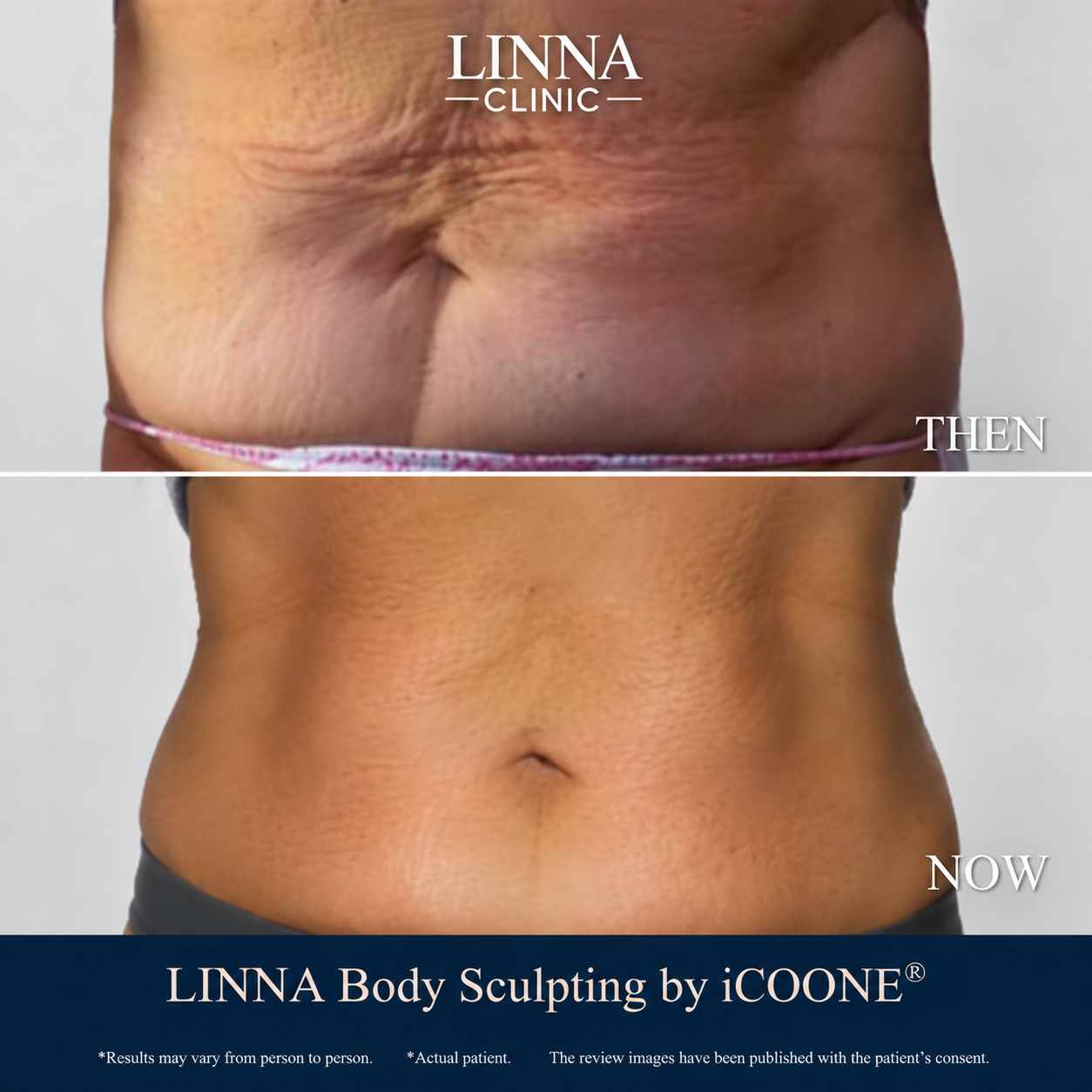 LINNA Body Sculpting by iCOONE® abdomen firming before and after