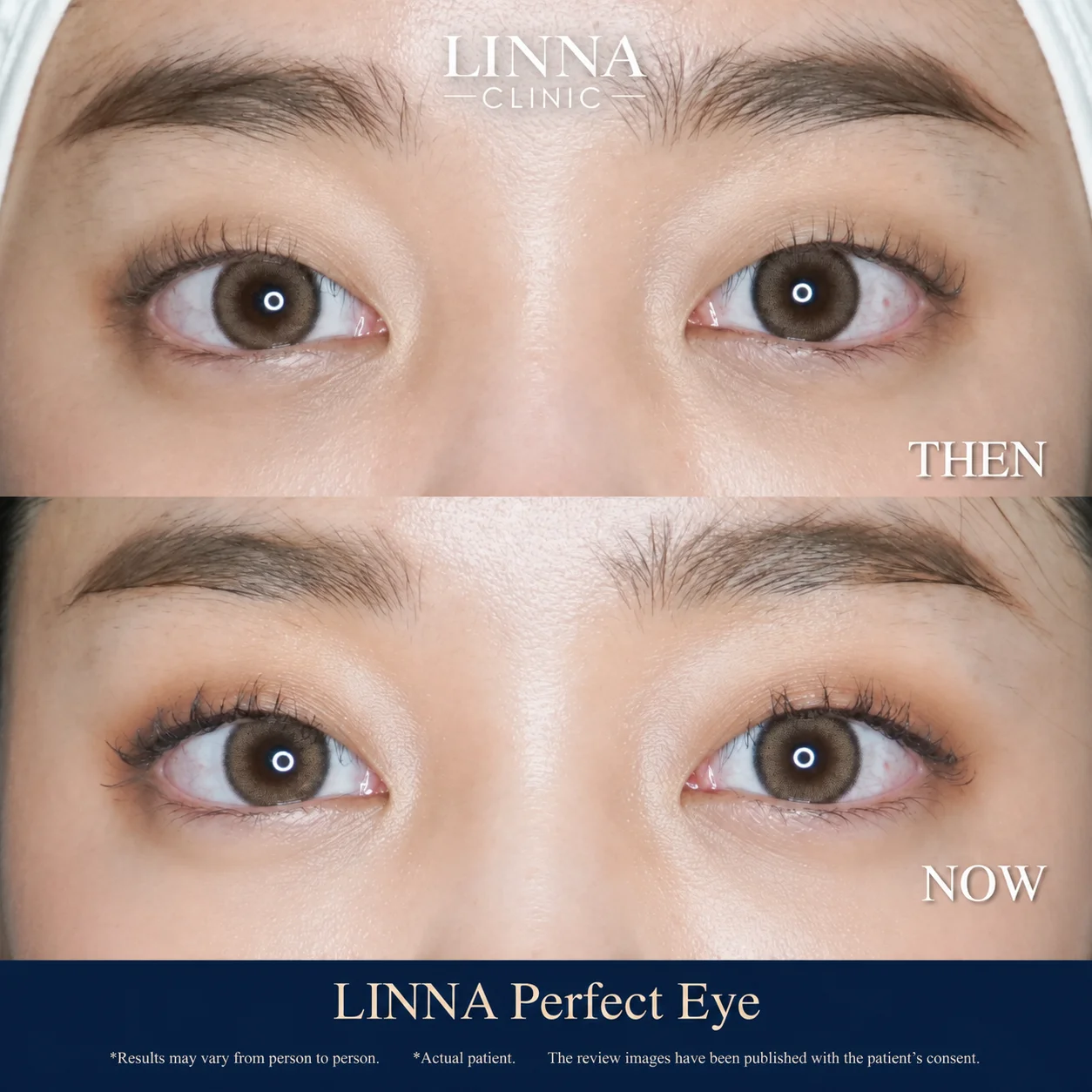 LINNA Perfect Eye before and after review 6