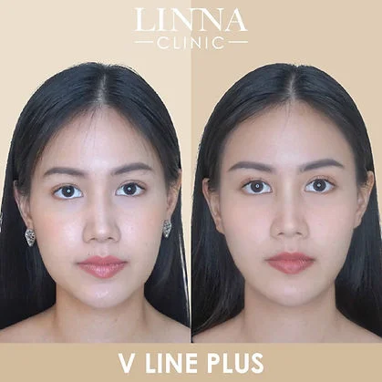 V Line Plus before and after