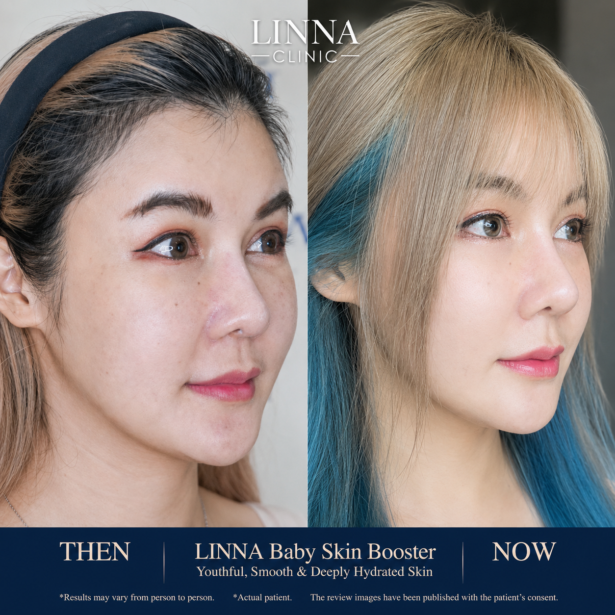 รีวิวก่อนและหลังทำ LINNA Baby Skin Booster