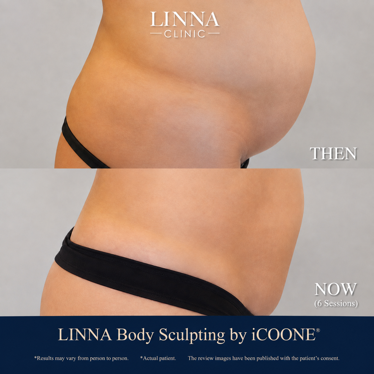 LINNA Body Sculpting by iCOONE® at LINNA Clinic