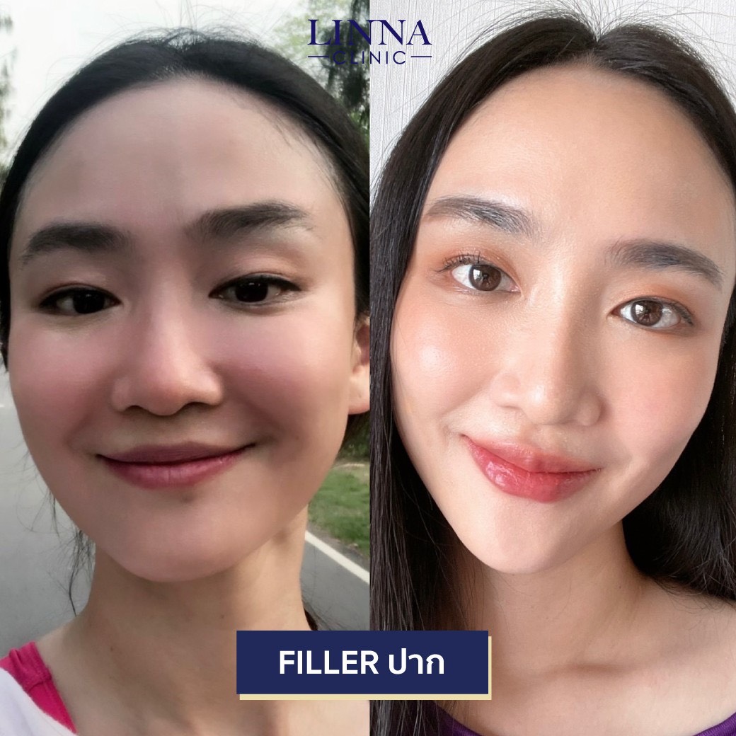 Lip filler before and after result at LINNA Clinic