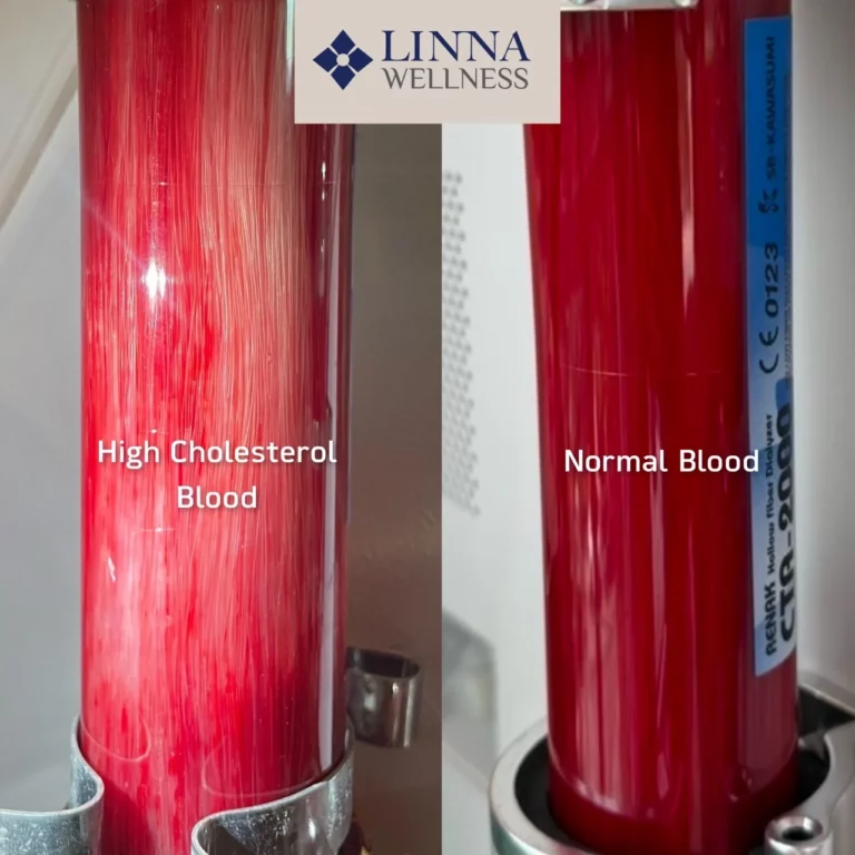EBOO Therapy (Ozone)