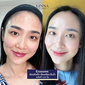 LINNA Clinic treatment result