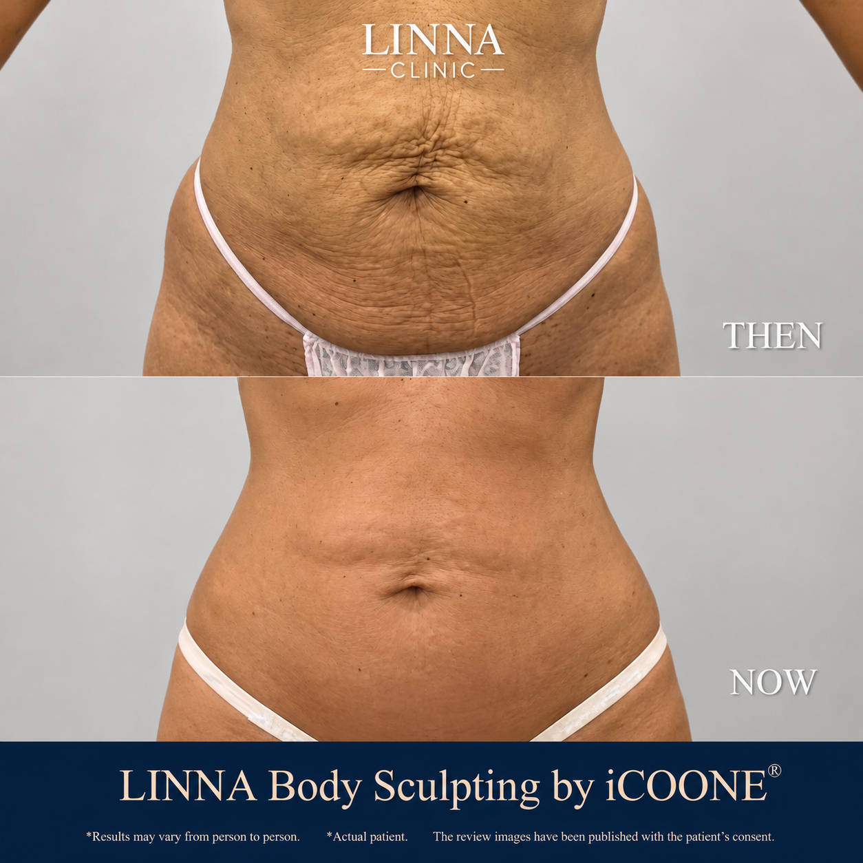 Before and after iCOONE results on the abdominal area