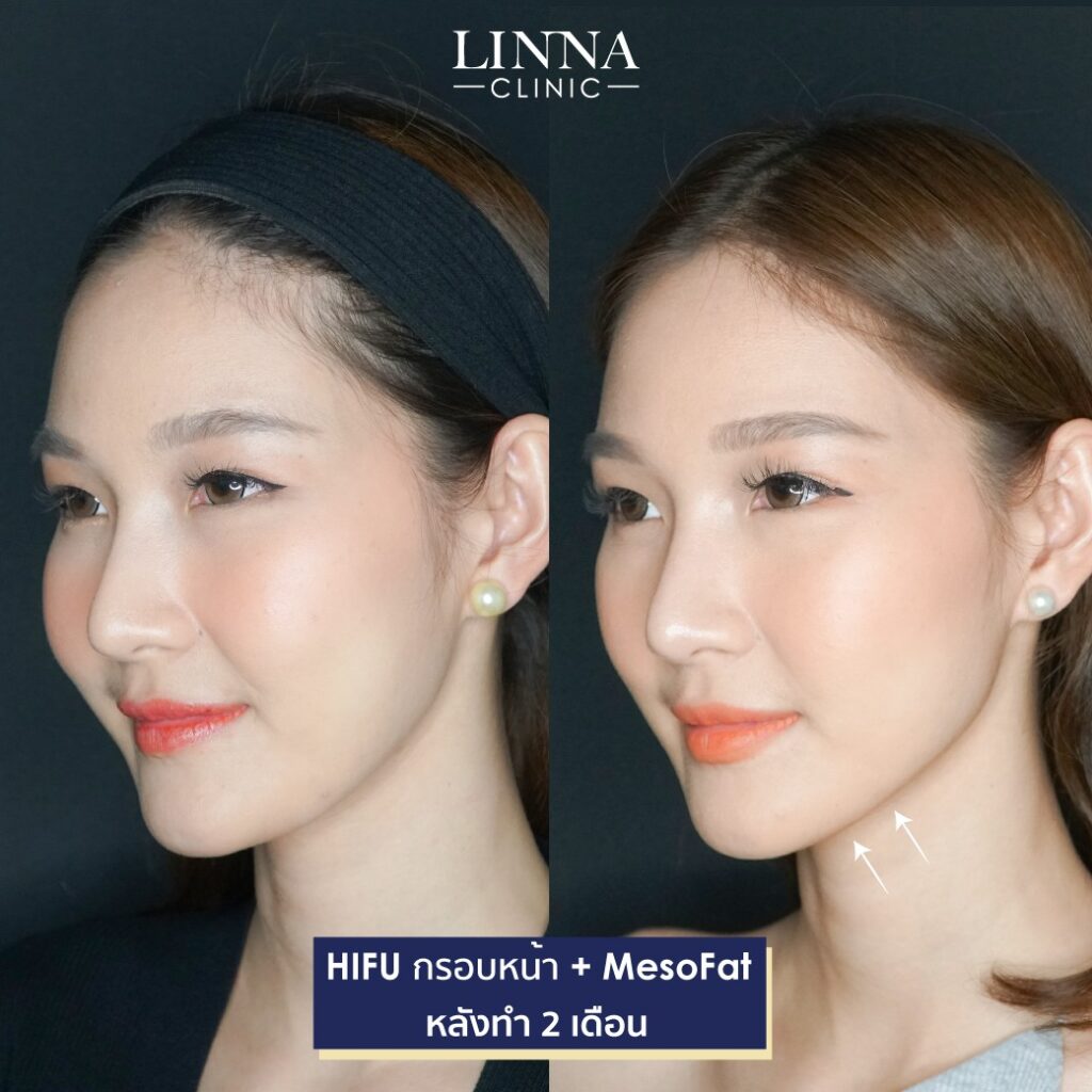 Dr. Phrutphailin Tantisinlaphong, M.D. — 2