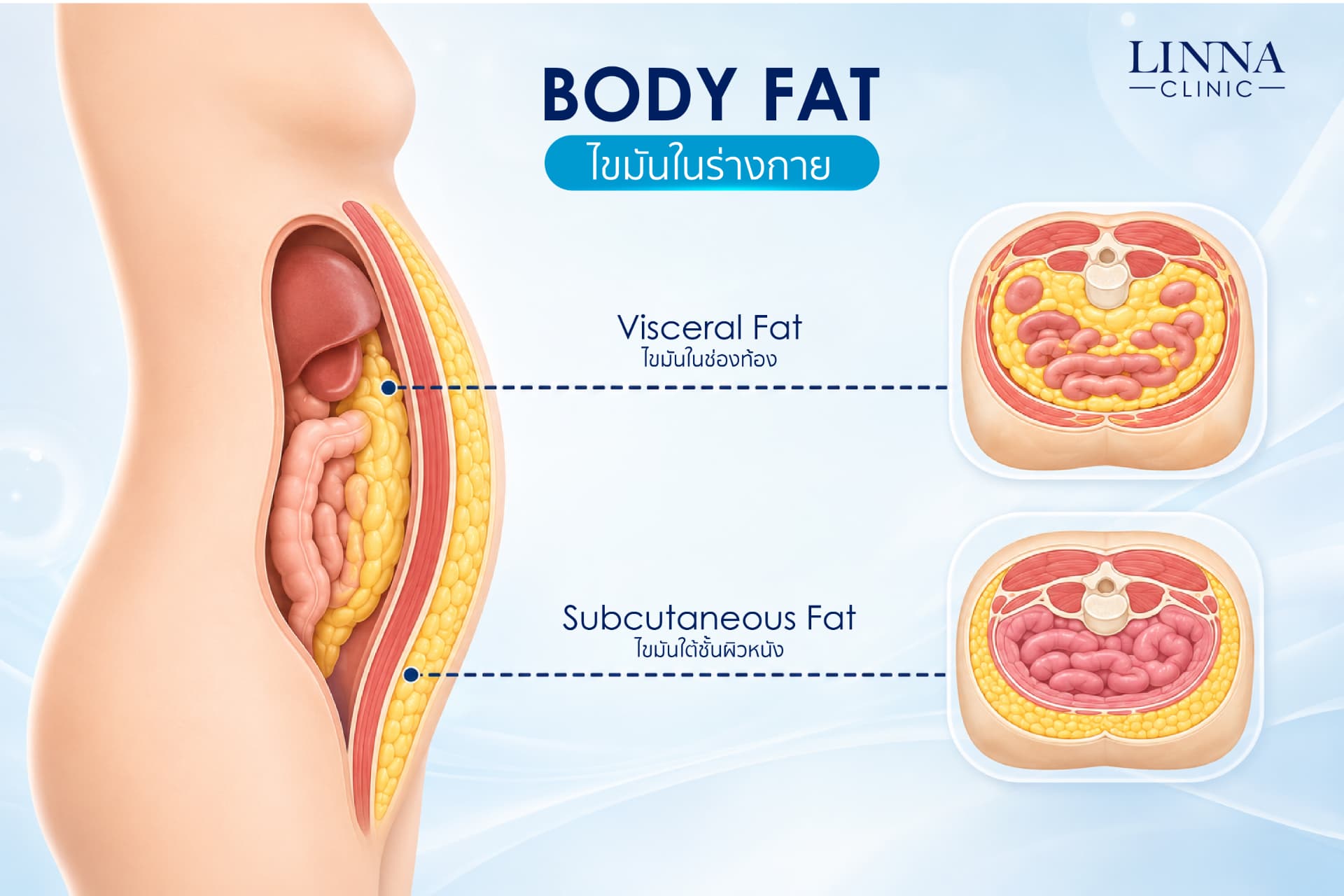 Fat layers targeted by Cool Swiss Prime Plus