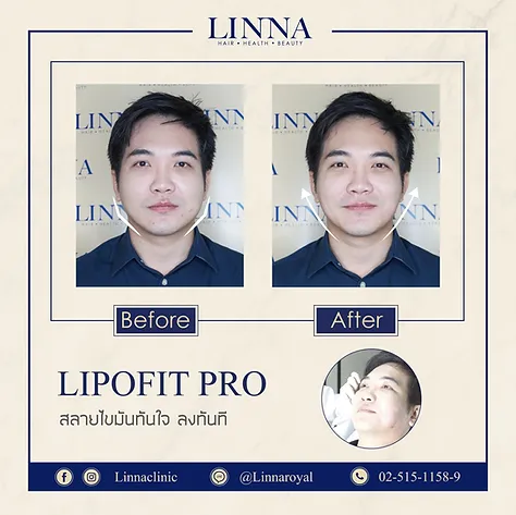 Lipofit Pro before and after