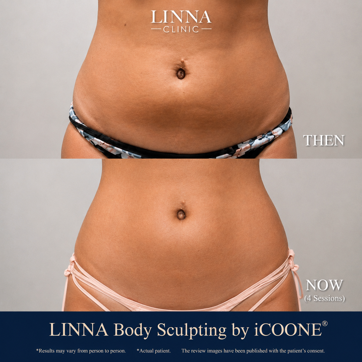 LINNA Body Sculpting by iCOONE® at LINNA Clinic