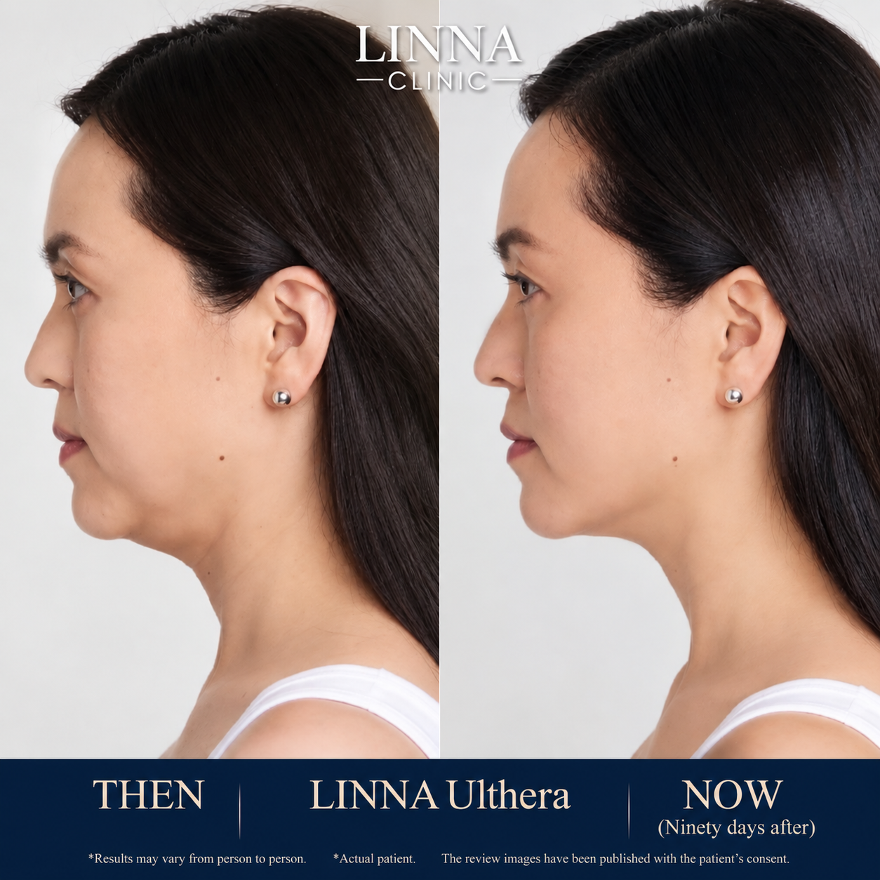 LINNA Ulthera SPT before and after result
