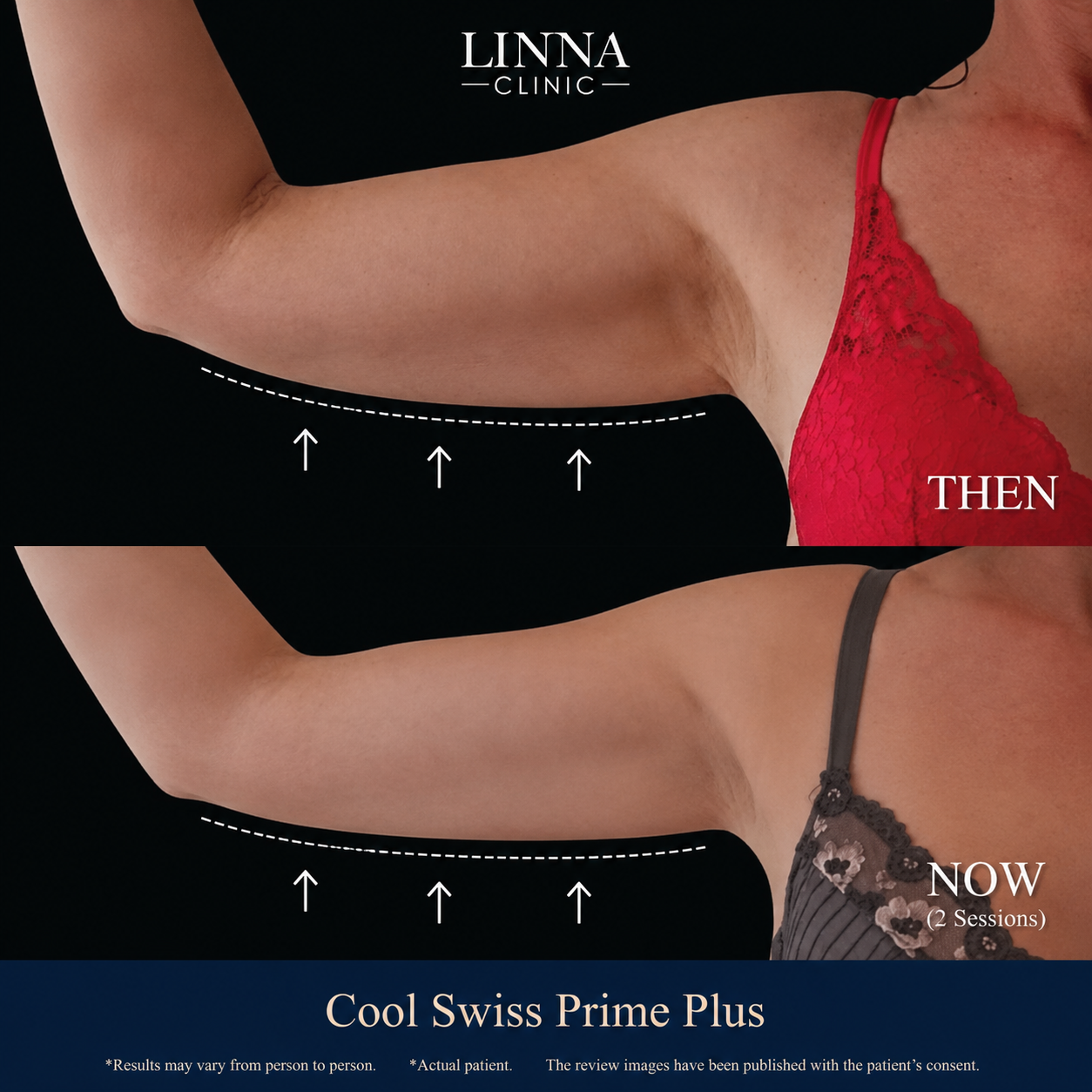 Cool Swiss Prime Plus results at LINNA Clinic