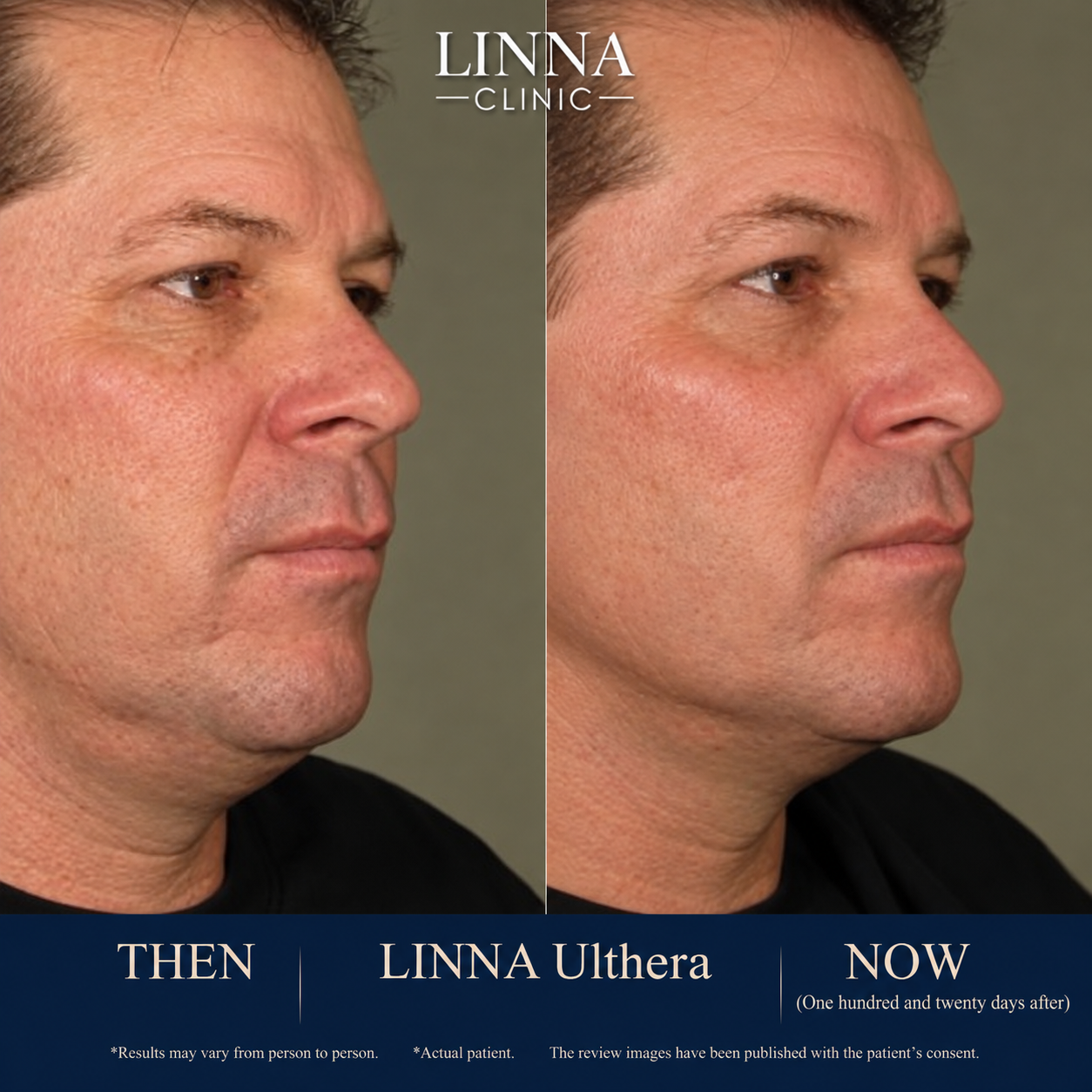 LINNA Ulthera SPT before and after result