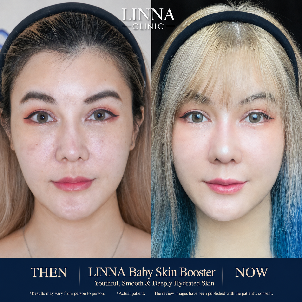 รีวิวก่อนและหลังทำ LINNA Baby Skin Booster