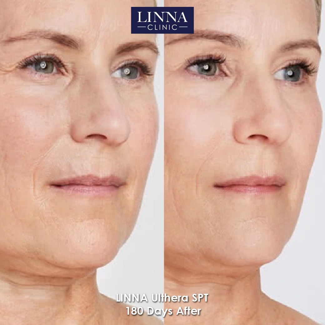 LINNA Ulthera SPT before and after result