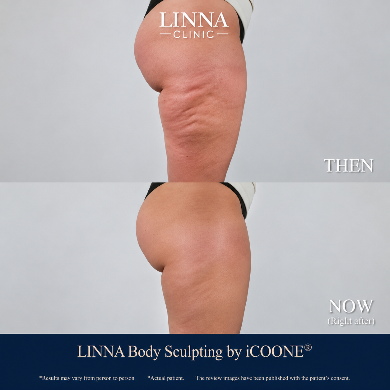 Before and after iCOONE results on the thigh and buttock area