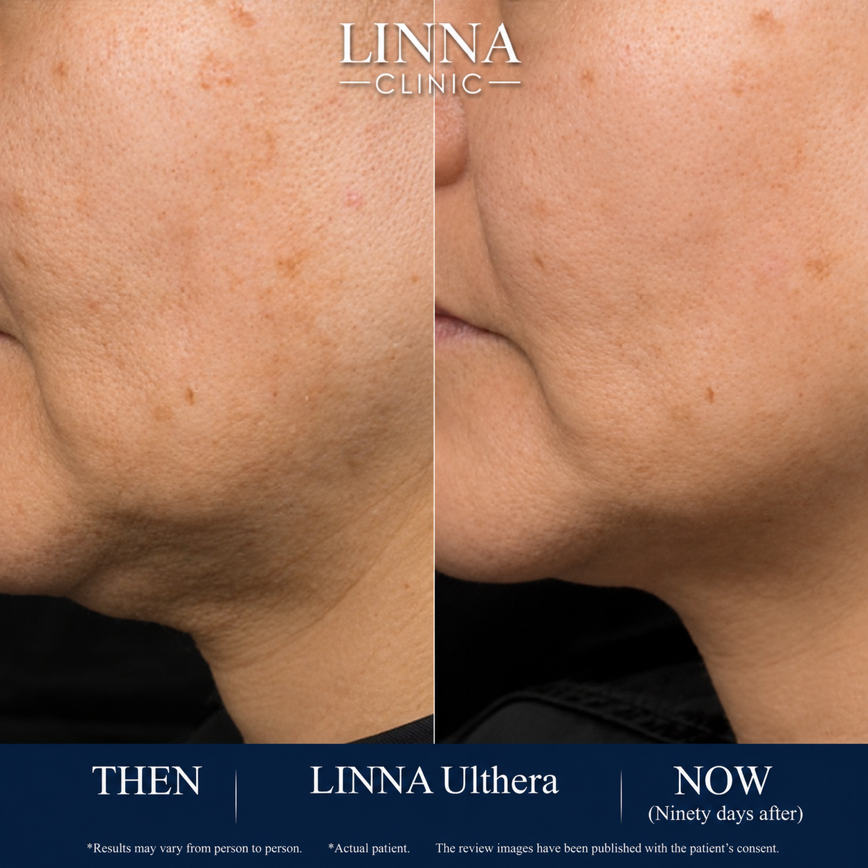 LINNA Ulthera SPT before and after result
