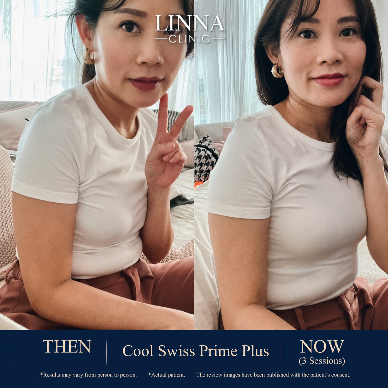 Cool Swiss Prime Plus results at LINNA Clinic