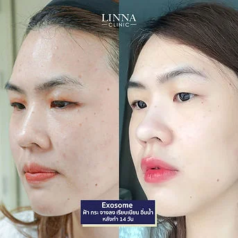 LINNA Clinic treatment result