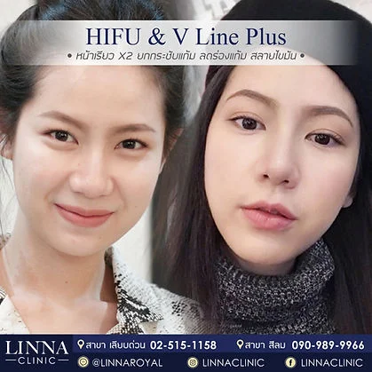 V Line Plus before and after