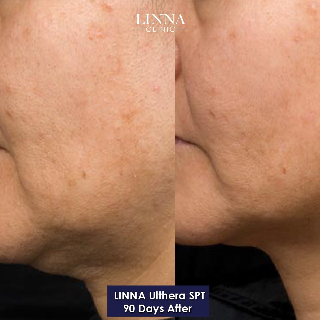 LINNA Ulthera SPT before and after result