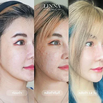 LINNA Clinic treatment result