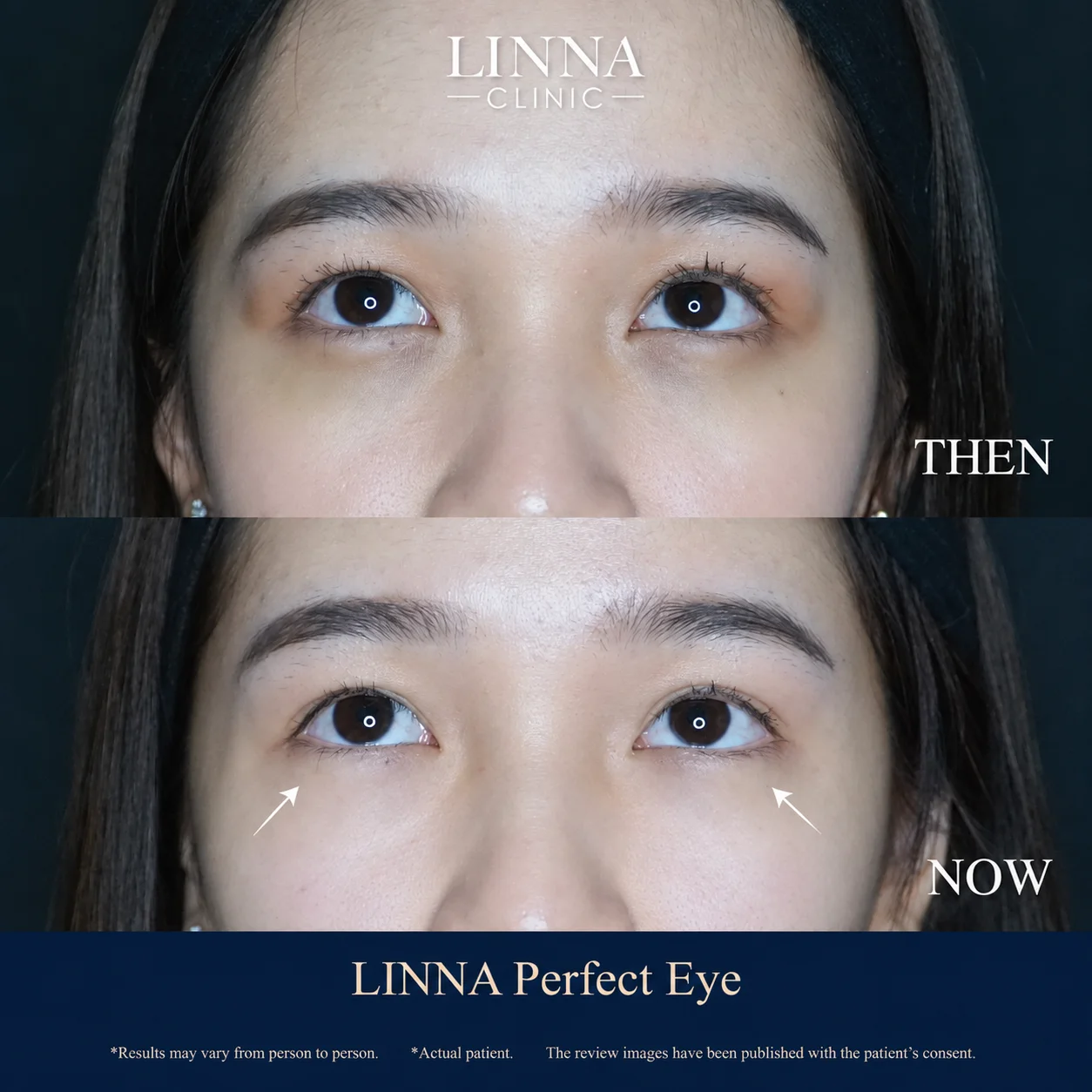 LINNA Perfect Eye before and after review 2