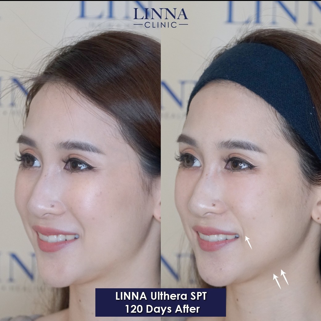 LINNA Ulthera SPT before and after result