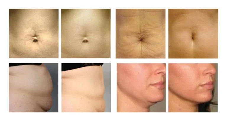 RF Pro before and after
