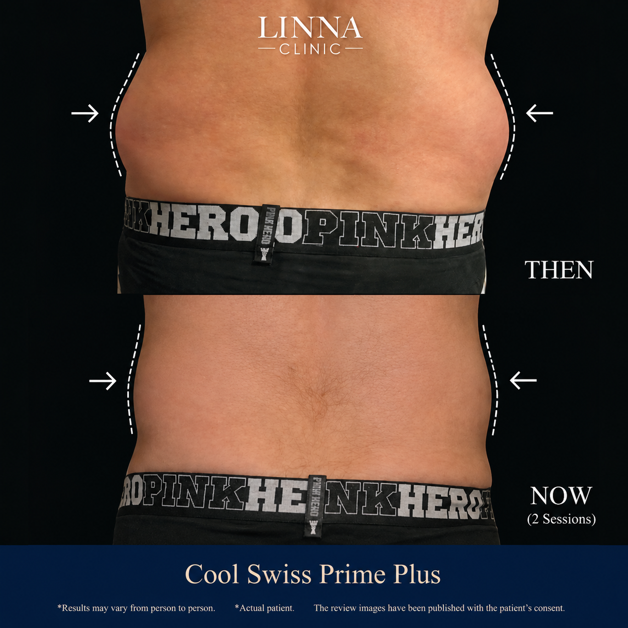 Cool Swiss Prime Plus results at LINNA Clinic