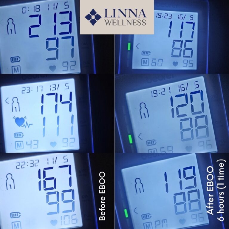EBOO Therapy (Ozone)