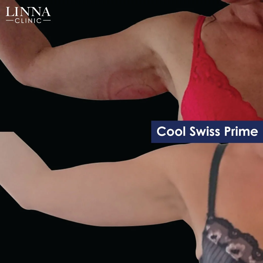 Cool Swiss Prime Plus results at LINNA Clinic