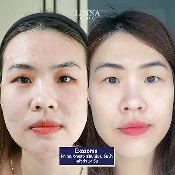 LINNA Clinic treatment result