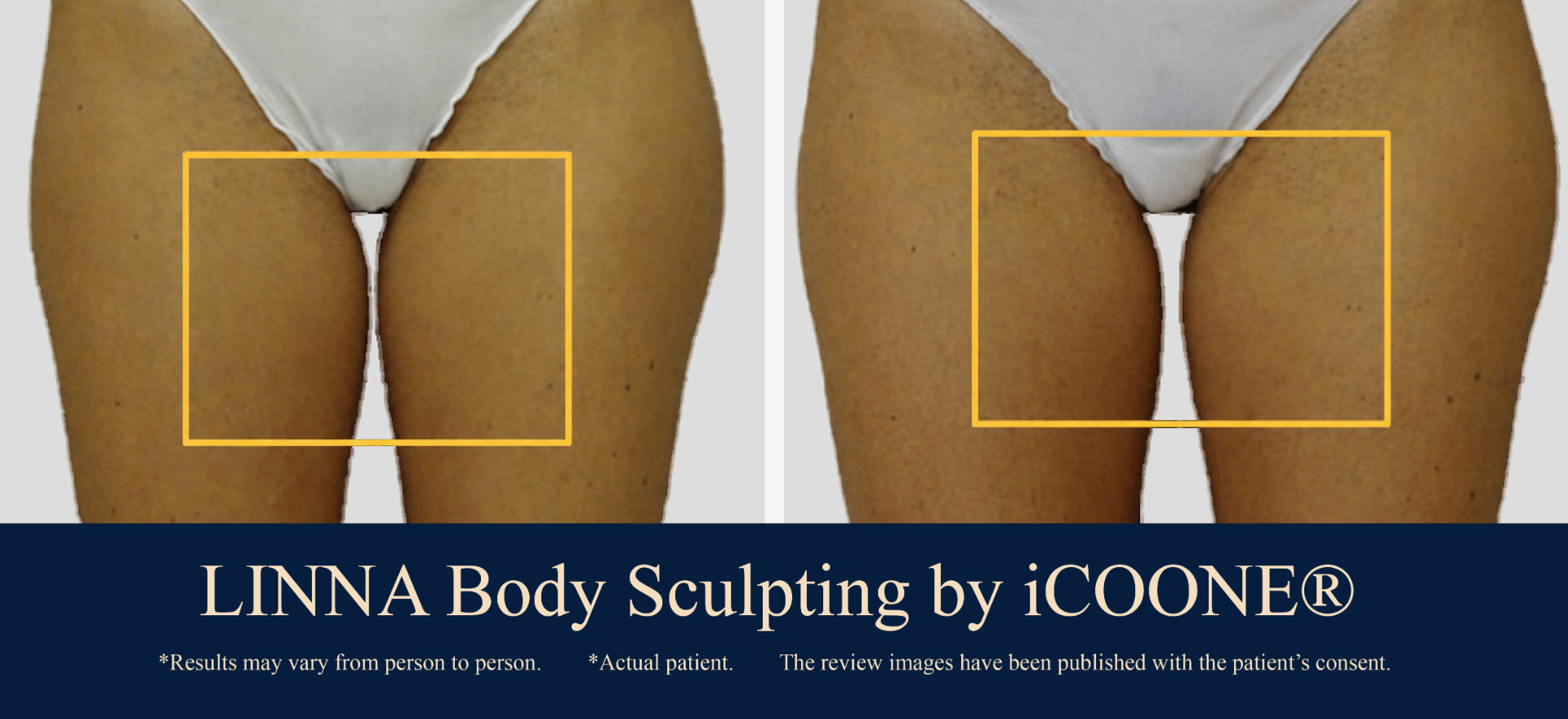 LINNA Body Sculpting by iCOONE® inner thighs before and after