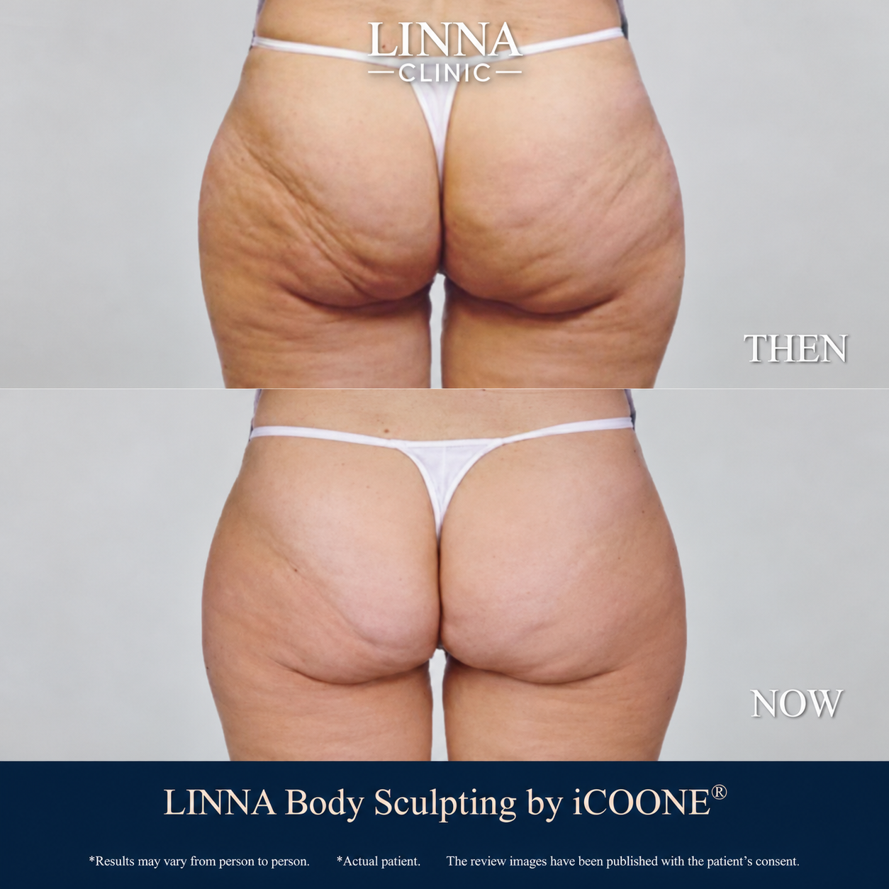 LINNA Body Sculpting by iCOONE® before and after comparison