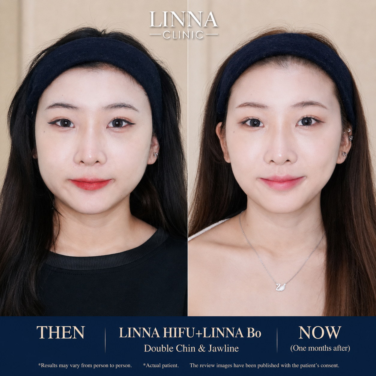 LINNA Clinic Bo ช่วยลดริ้วรอย ปรับรูปหน้าและรูปคิ้ว ไม่มีผลข้างเคียงและไม่ทิ้งสารตกค้างภายในร่างกาย