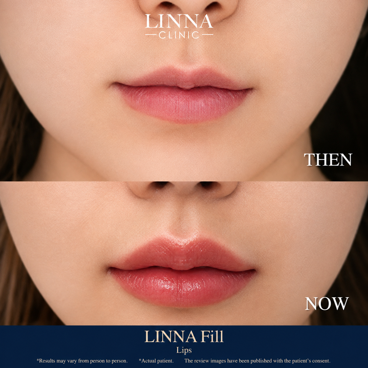 LINNA Fill lips before and after