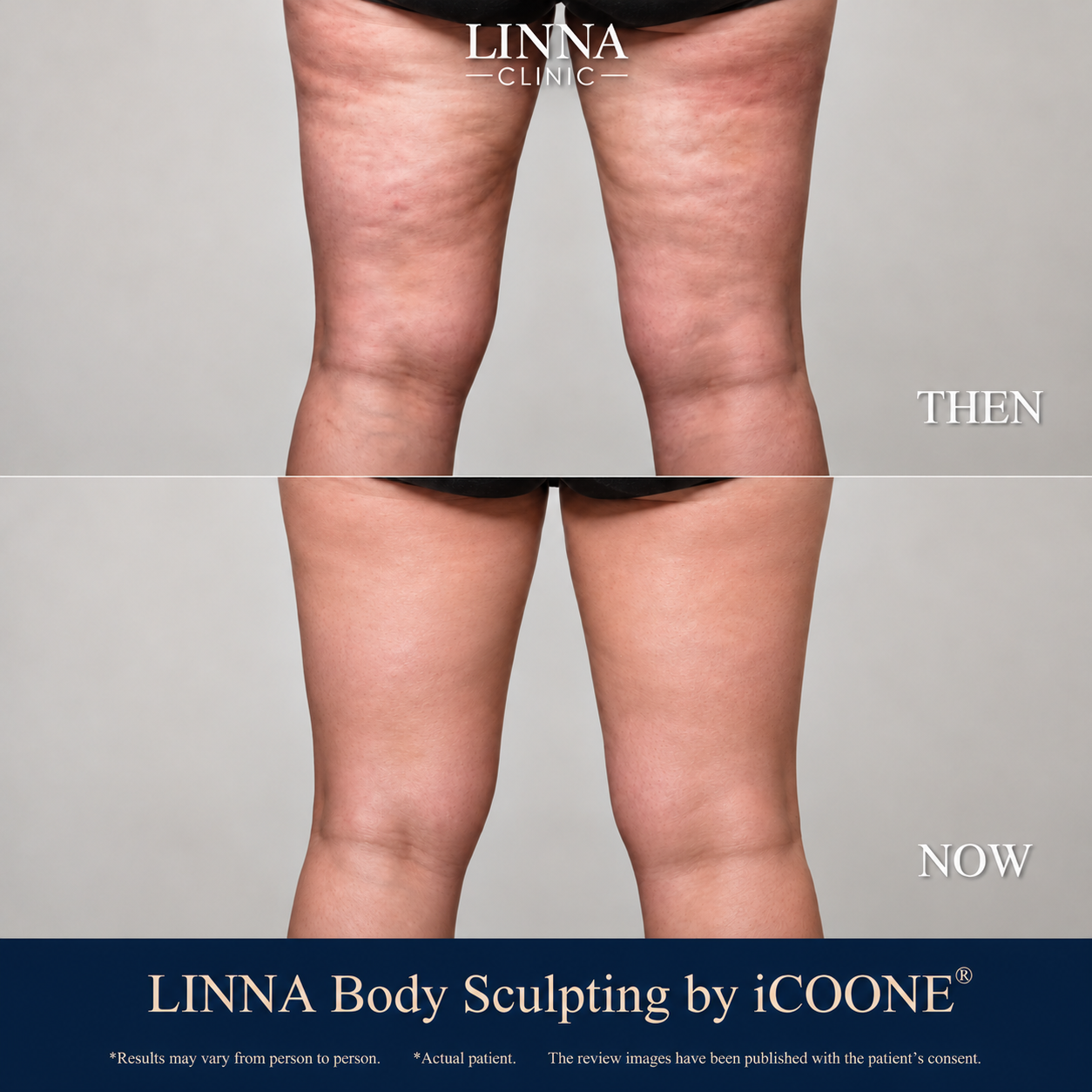 Wavy and uneven thigh skin before and after Body Sculpting by iCOONE®