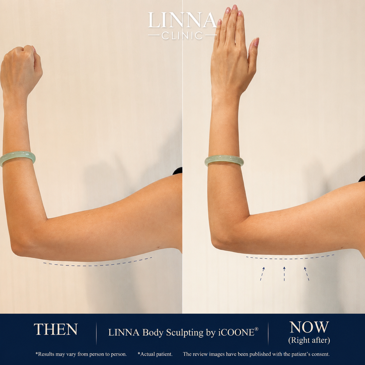 LINNA Body Sculpting by iCOONE® at LINNA Clinic
