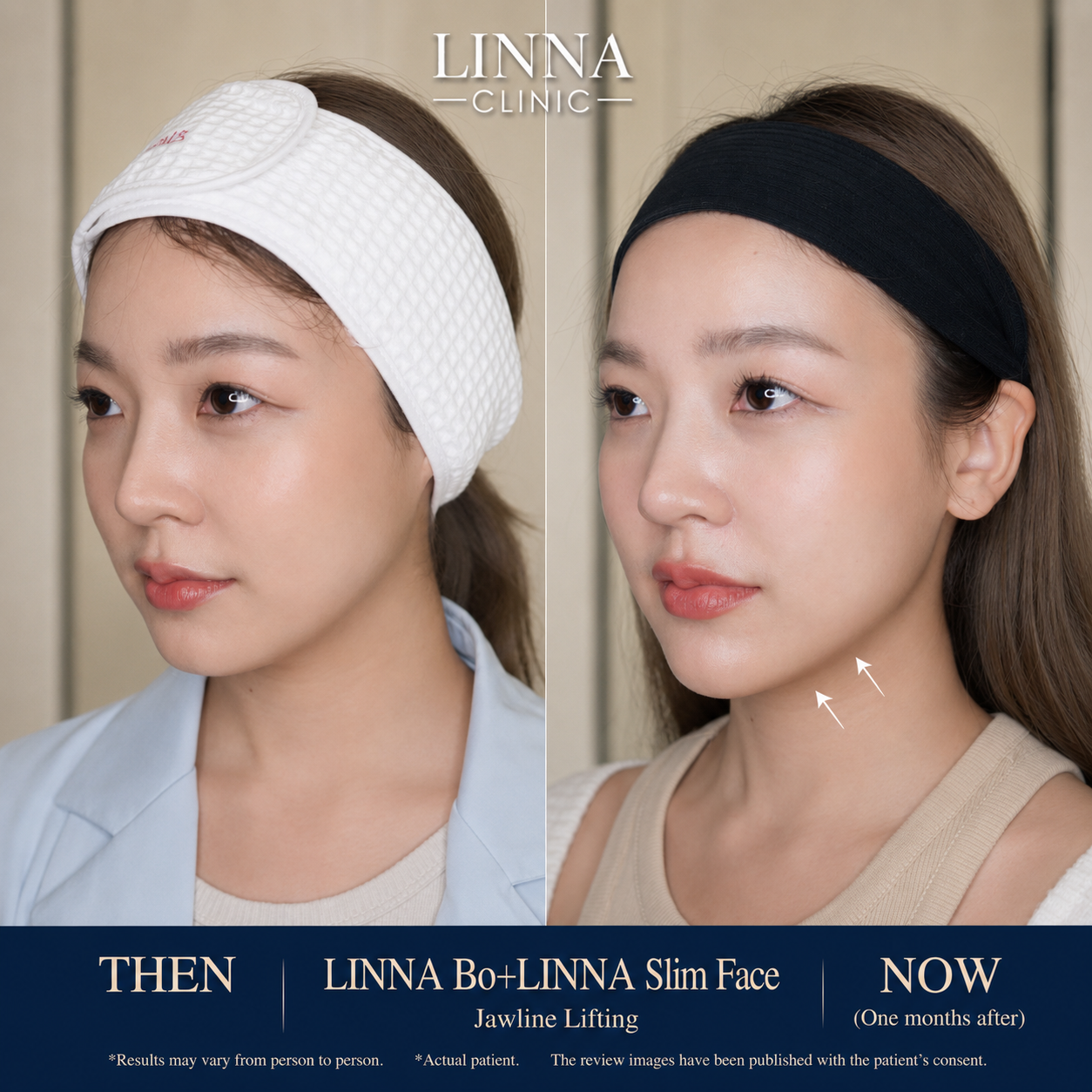 LINNA Clinic Bo ช่วยลดริ้วรอย ปรับรูปหน้าและรูปคิ้ว ไม่มีผลข้างเคียงและไม่ทิ้งสารตกค้างภายในร่างกาย