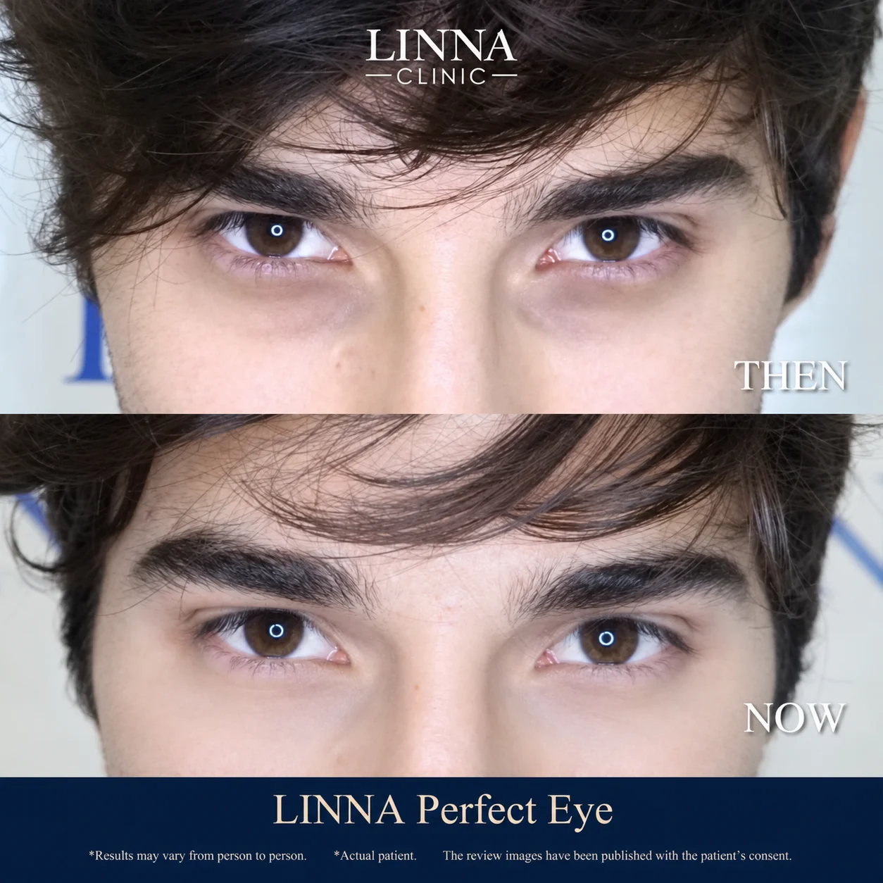 LINNA Perfect Eye before and after review 7