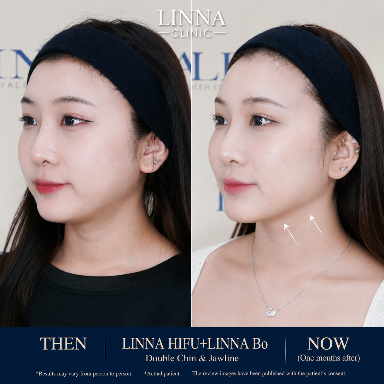 LINNA Clinic Bo ช่วยลดริ้วรอย ปรับรูปหน้าและรูปคิ้ว ไม่มีผลข้างเคียงและไม่ทิ้งสารตกค้างภายในร่างกาย