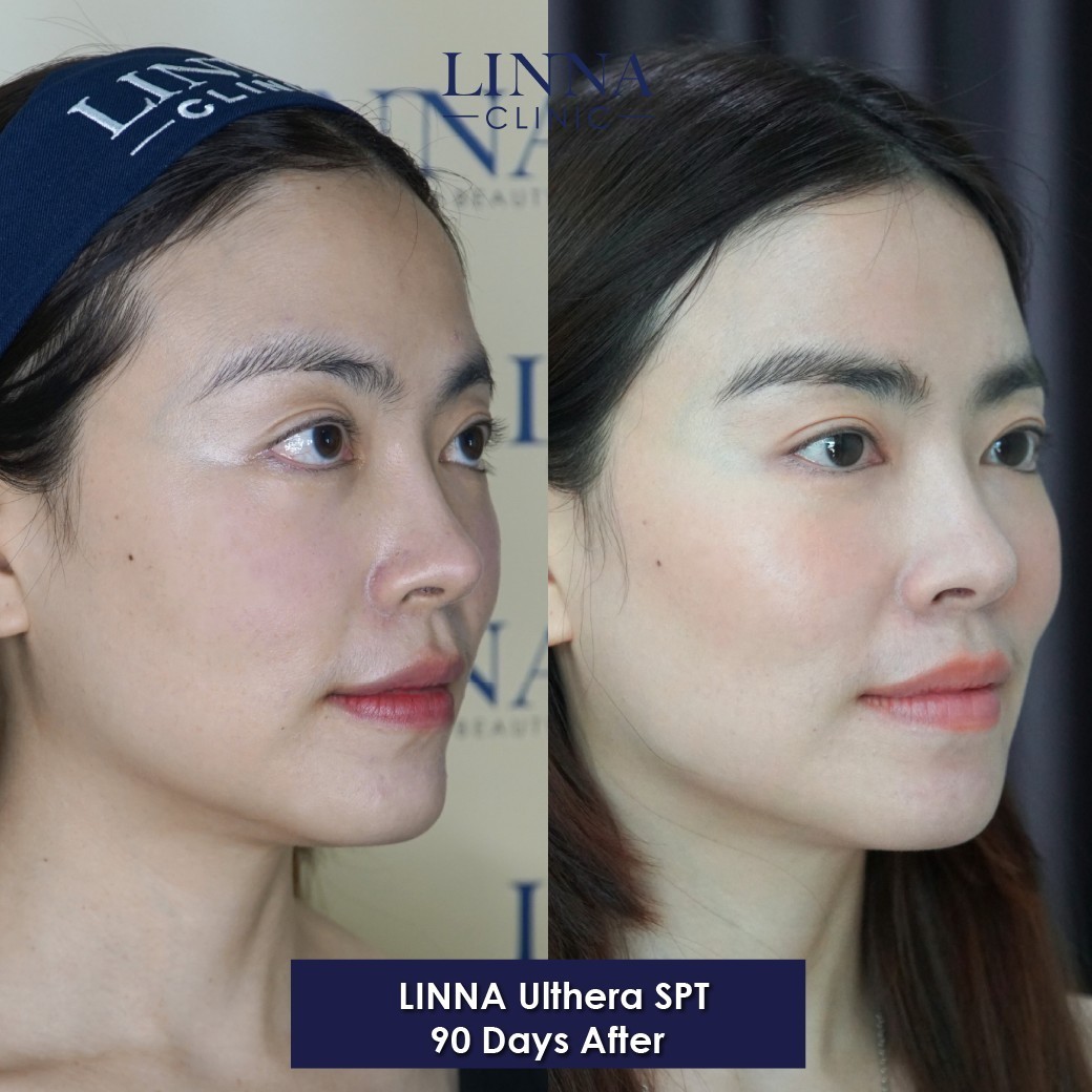 LINNA Ulthera SPT before and after result