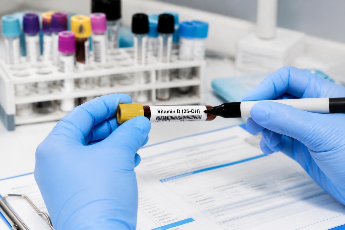 Vitamin D 25-OH blood test at LINNA Clinic laboratory