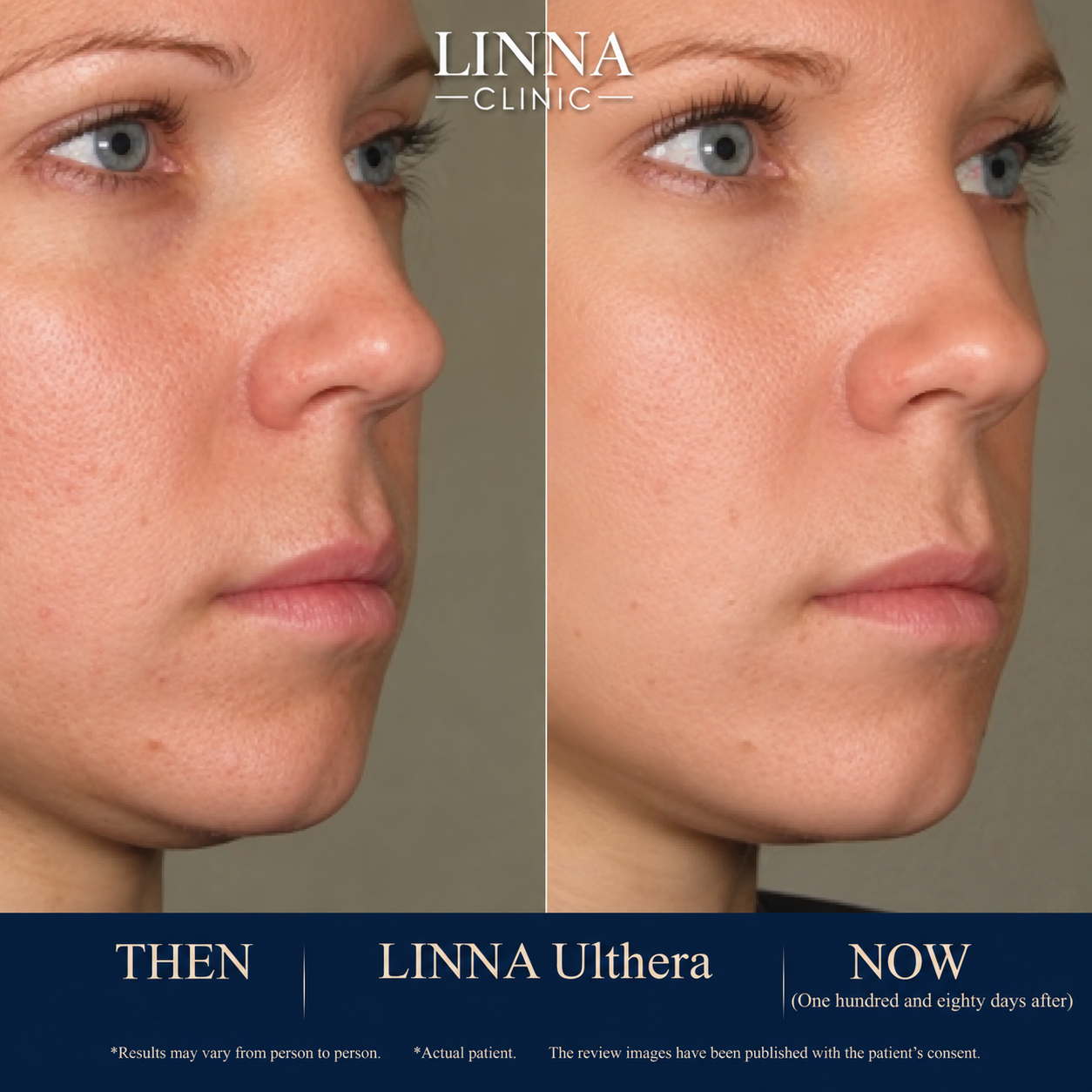 LINNA Ulthera SPT before and after result