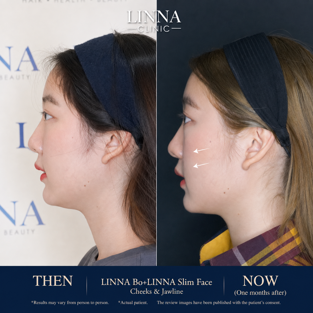 LINNA Clinic Bo ช่วยลดริ้วรอย ปรับรูปหน้าและรูปคิ้ว ไม่มีผลข้างเคียงและไม่ทิ้งสารตกค้างภายในร่างกาย