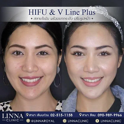 V Line Plus before and after