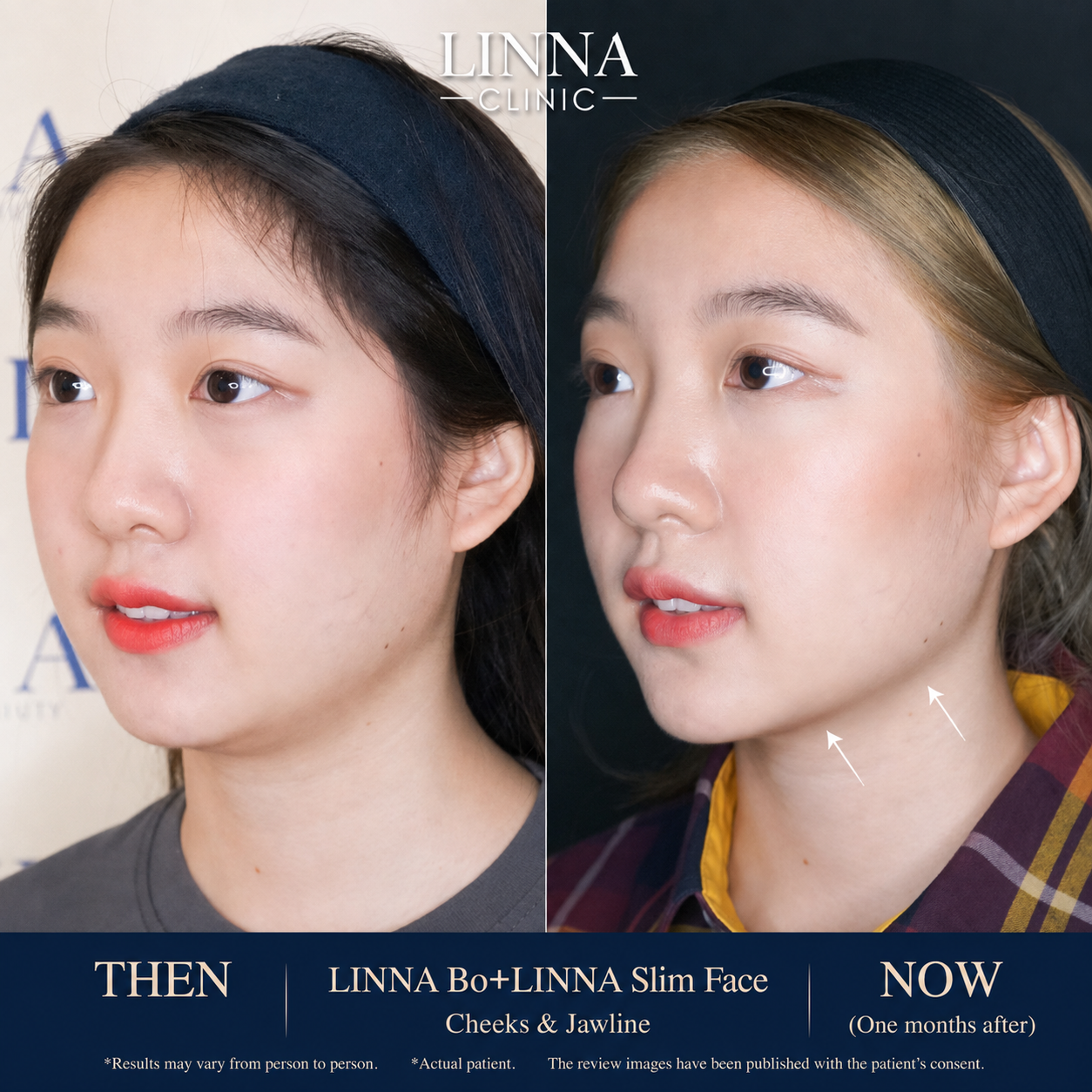 LINNA Clinic Bo ช่วยลดริ้วรอย ปรับรูปหน้าและรูปคิ้ว ไม่มีผลข้างเคียงและไม่ทิ้งสารตกค้างภายในร่างกาย