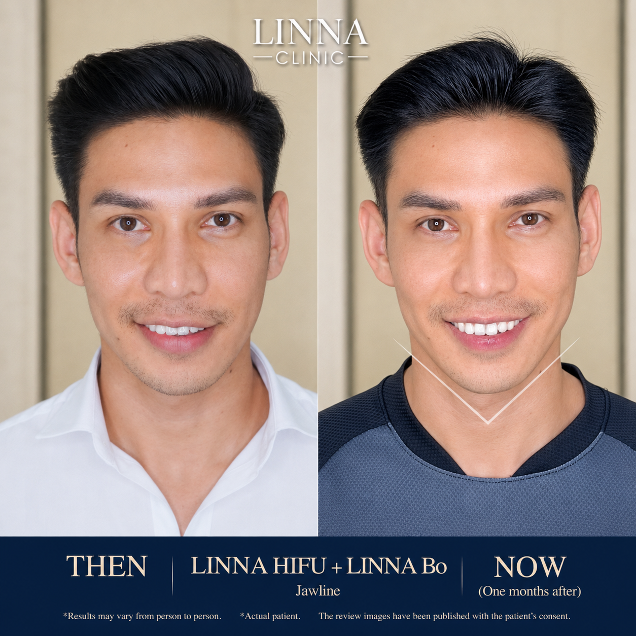 LINNA Clinic Bo ช่วยลดริ้วรอย ปรับรูปหน้าและรูปคิ้ว ไม่มีผลข้างเคียงและไม่ทิ้งสารตกค้างภายในร่างกาย