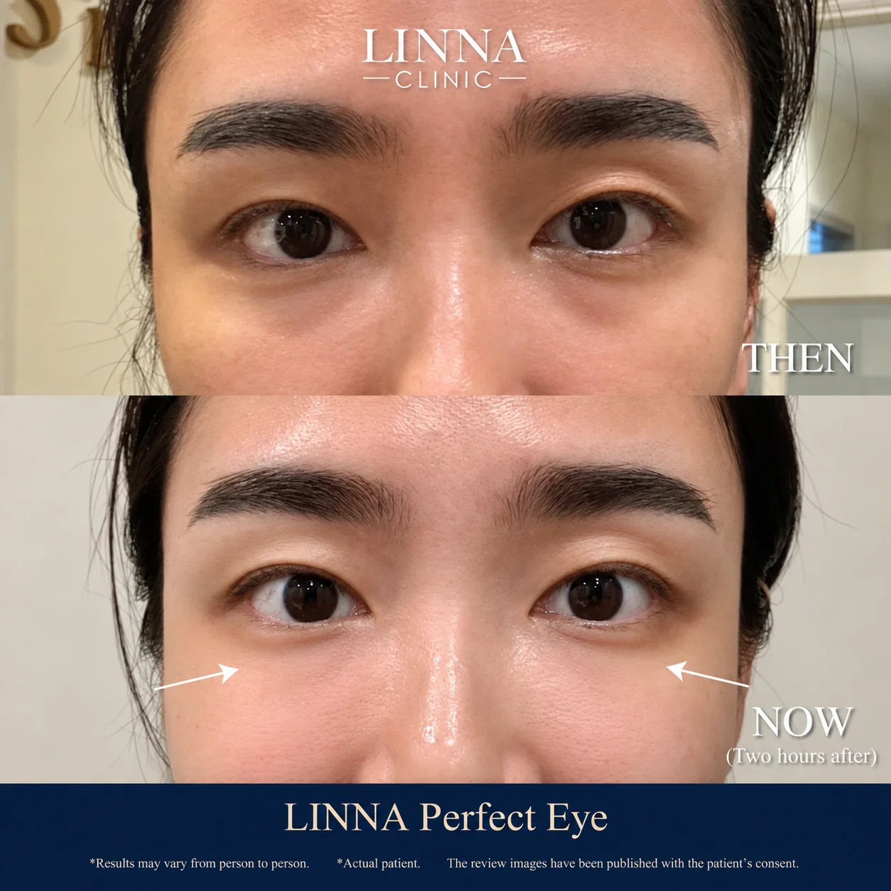 LINNA Perfect Eye before and after review 1