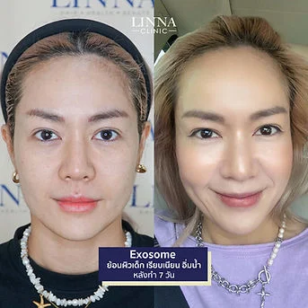 LINNA Clinic treatment result